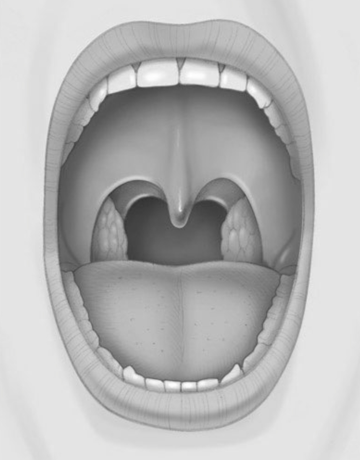 Tonsillitis and Tonsillectomy