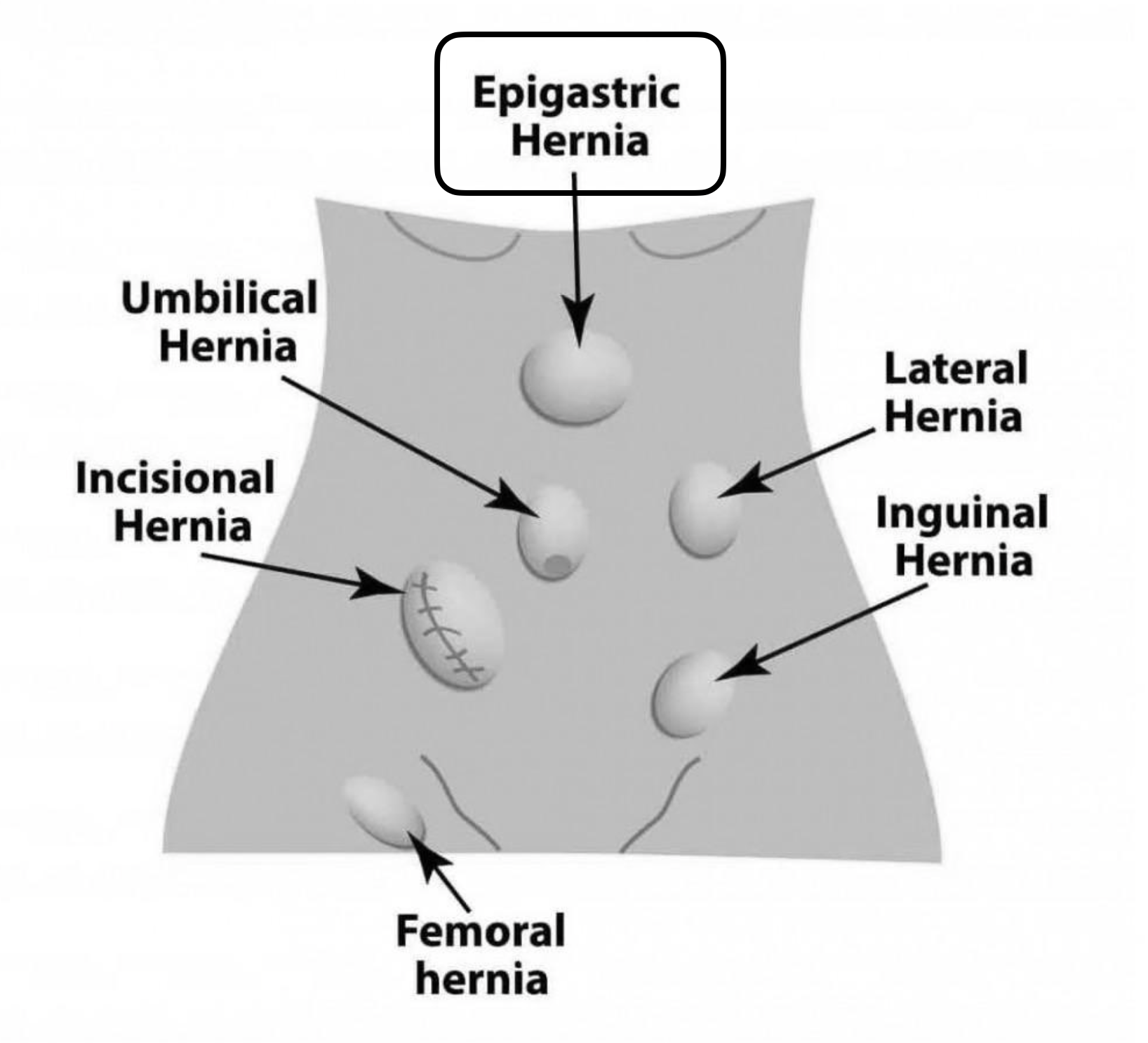 Epigastric Hernia