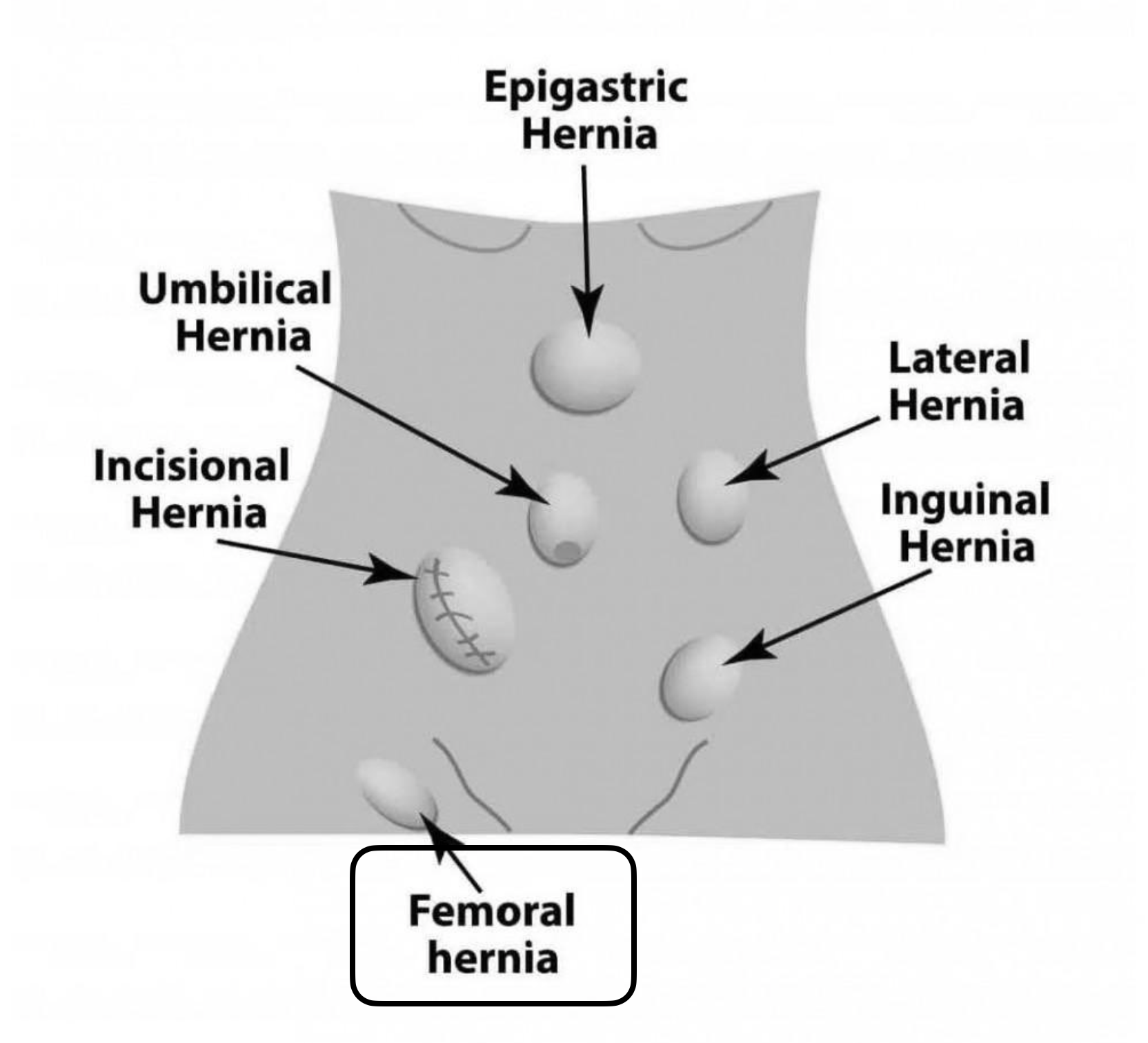 Femoral Hernia