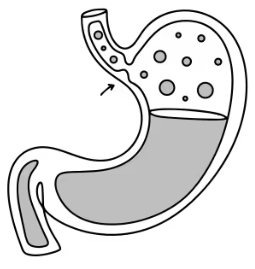 Gastroesophageal Reflux