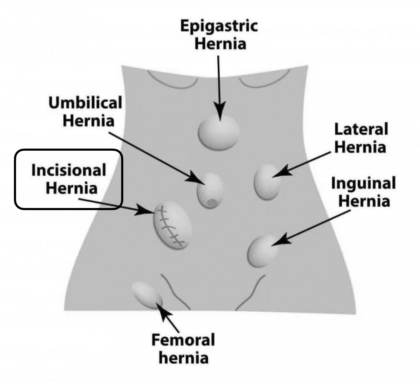 Incisional Hernia