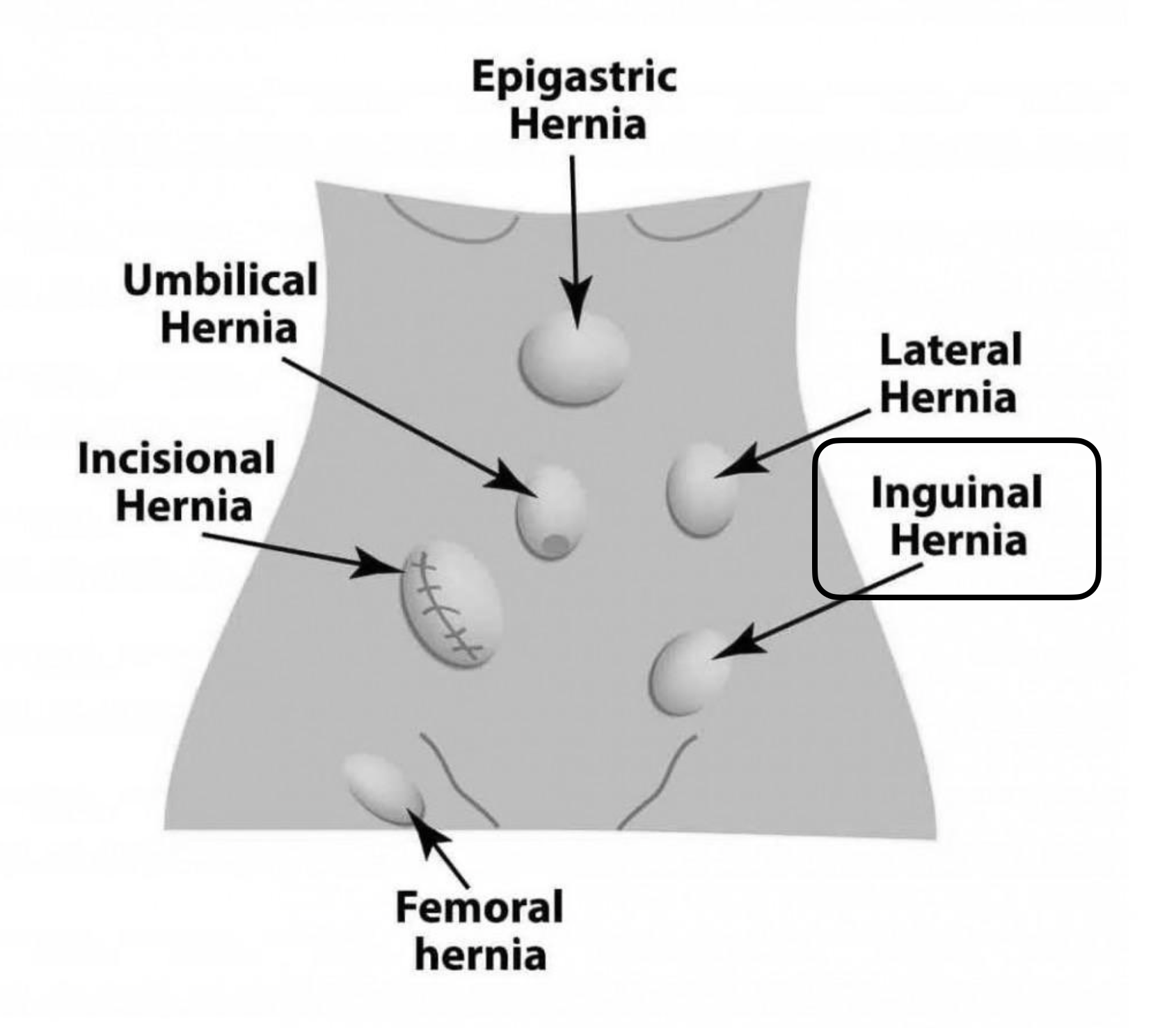 Inguinal Hernia