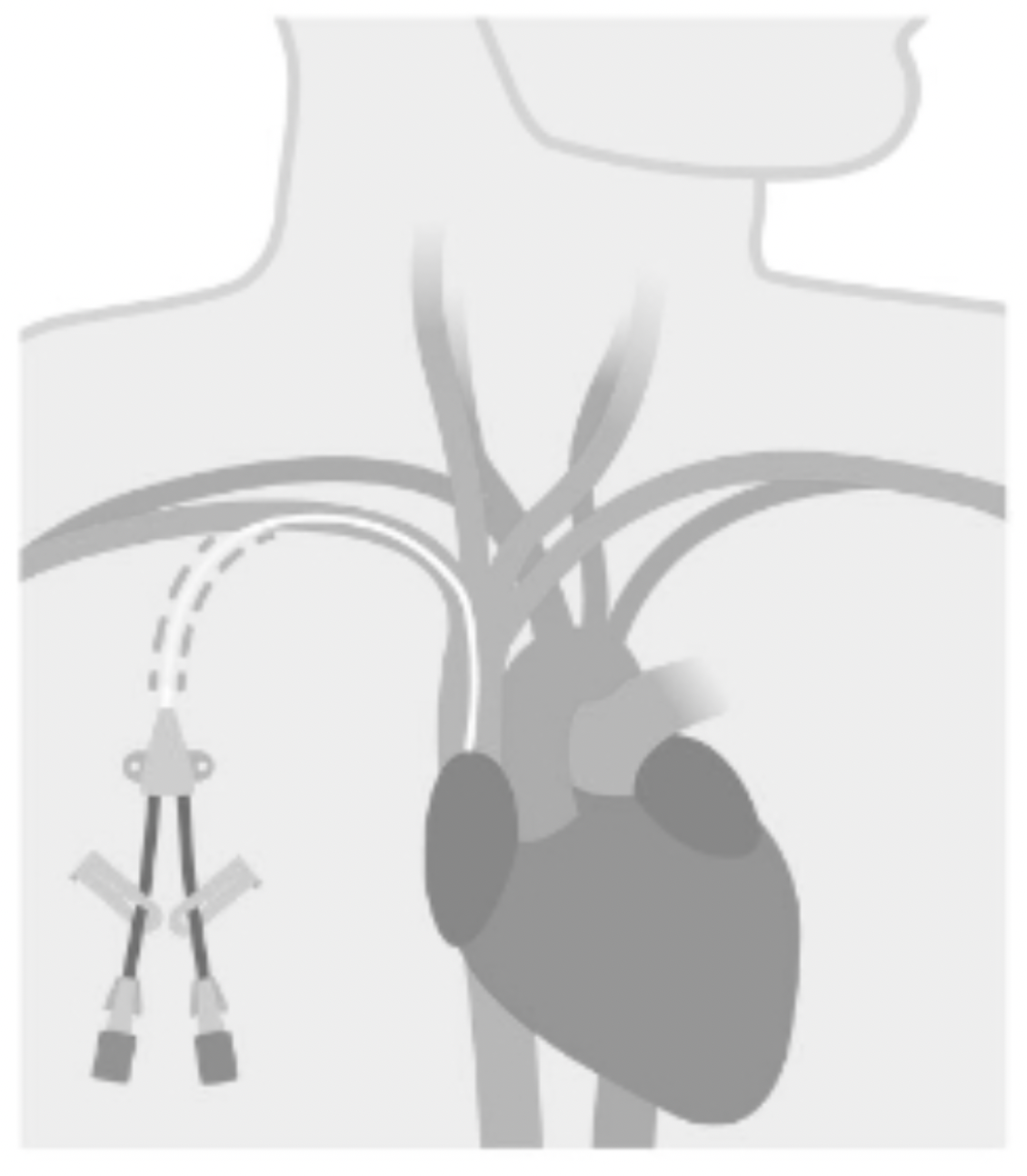 Port Placement