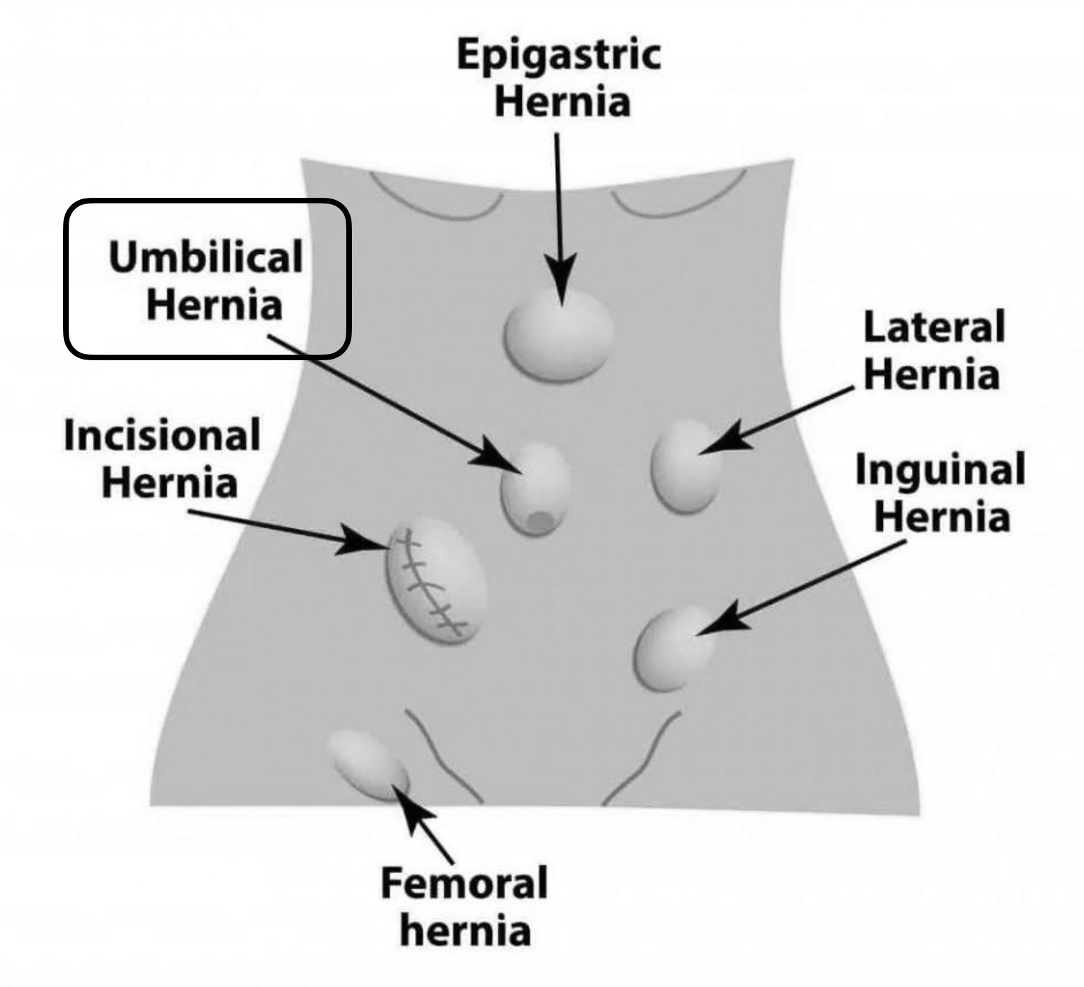 Umbilical Hernia
